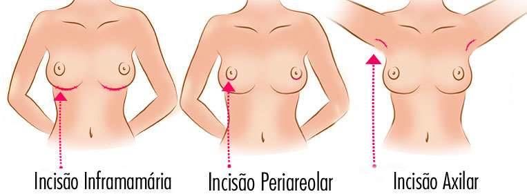 Razilly - Cirurgia Plstica e Neurologia Incises e Cicatrizao Qual incisão será feita e como ficará a cicatriz de implante da prótese mamária é uma das dúvidas mais recorrentes das mulheres....
